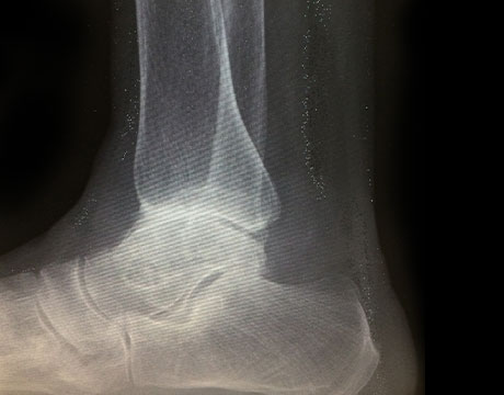 変形性足関節症　手術前　側面　X線写真