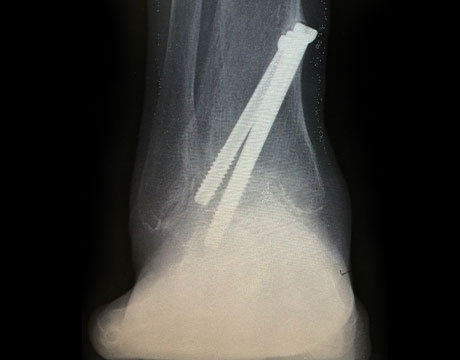 変形性足関節症　手術後　正面　X線写真