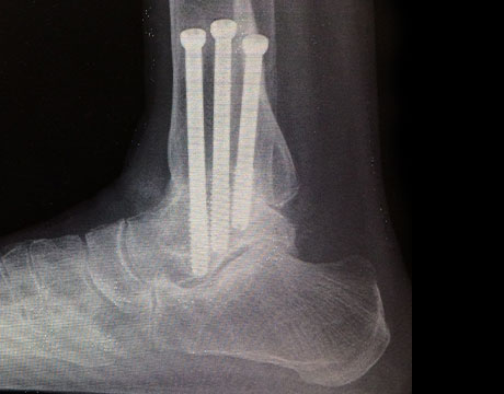 変形性足関節症　手術後　側面　X線写真