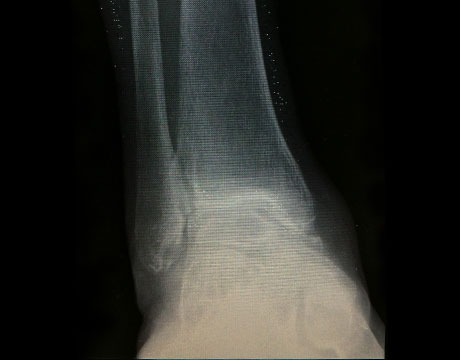 変形性足関節症　手術前　正面　X線写真