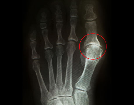 強剛母趾　手術前　正面　X線写真