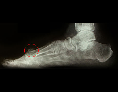 強剛母趾　手術前　側面　X線写真