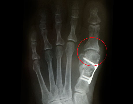 強剛母趾　手術後　正面　X線写真