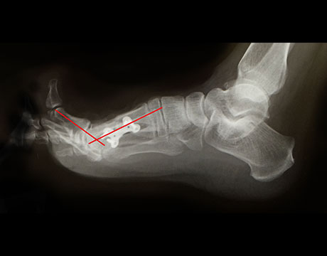 強剛母趾　手術後　側面　X線写真