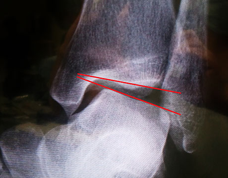 足関節外側靭帯損傷　手術前　X線写真